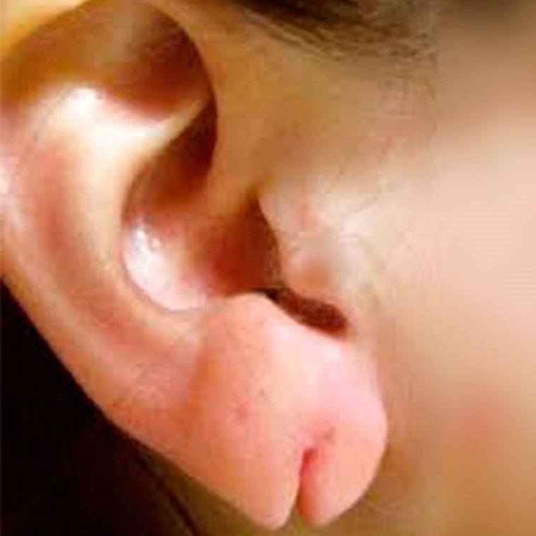 Corrección de lóbulo de la oreja